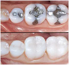 Amalgam Composite