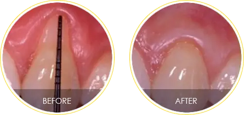 Gum Recession