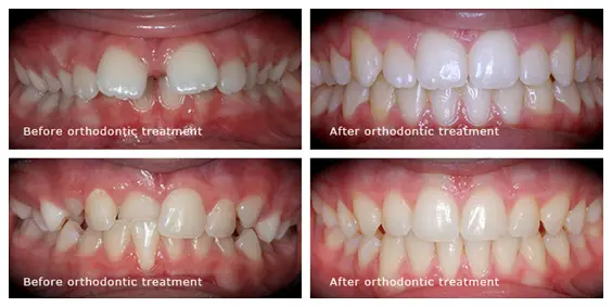 Before-After